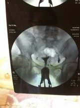 子宫憩室积液怎样排出？做试管移植前有积液怎么办？